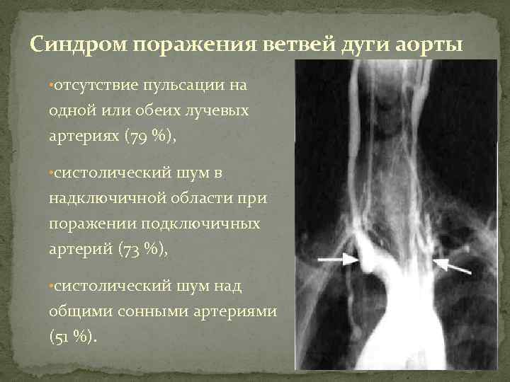 Синдром поражения ветвей дуги аорты • отсутствие пульсации на одной или обеих лучевых артериях