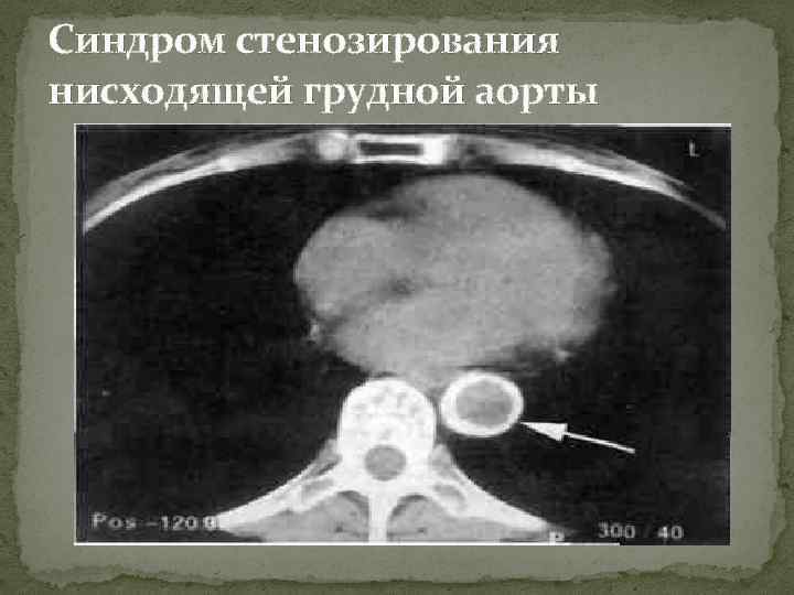 Синдром стенозирования нисходящей грудной аорты 