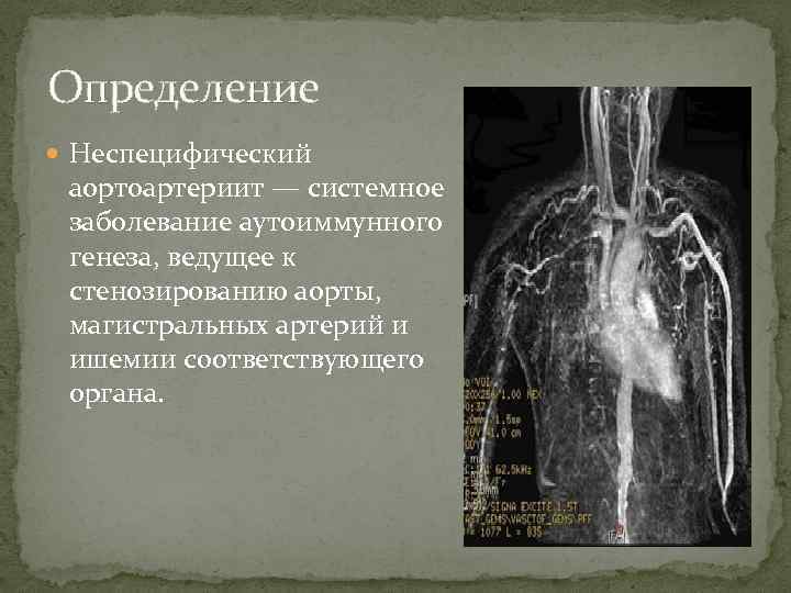 Неспецифический генез. Неспецифический аортоартериит. Формы неспецифического аортоартериита:. Неспецифический аортоартериит критерии. Неспецифический аортоартериит профилактика.