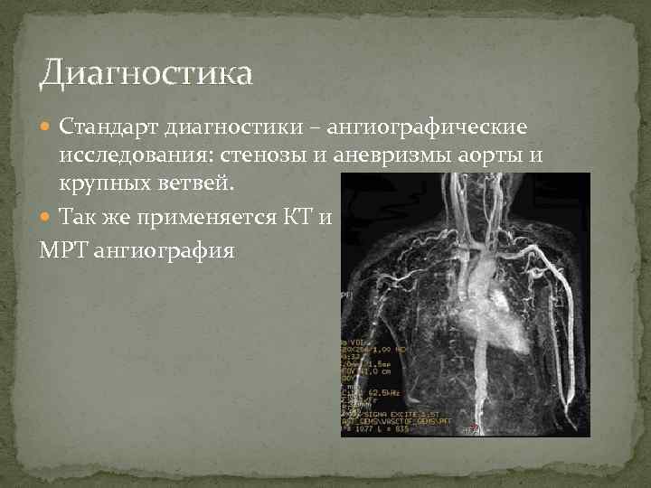 Диагностика Стандарт диагностики – ангиографические исследования: стенозы и аневризмы аорты и крупных ветвей. Так