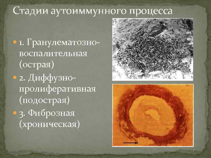 Стадии аутоиммунного процесса 1. Гранулематозно воспалительная (острая) 2. Диффузно пролиферативная (подострая) 3. Фиброзная (хроническая)