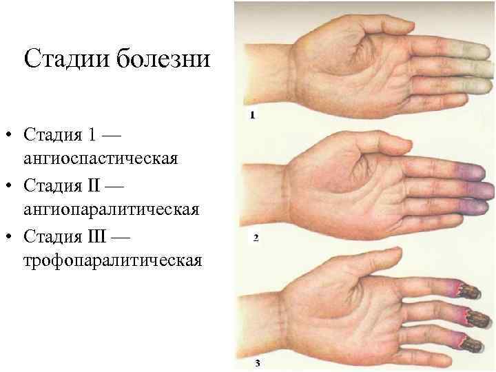 Стадии болезни • Стадия 1 — ангиоспастическая • Стадия II — ангиопаралитическая • Стадия