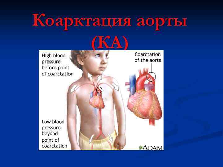 Коарктация аорты (КА) 