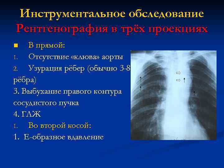 Инструментальное обследование Рентгенография в трёх проекциях В прямой: 1. Отсутствие «клюва» аорты 2. Узурация