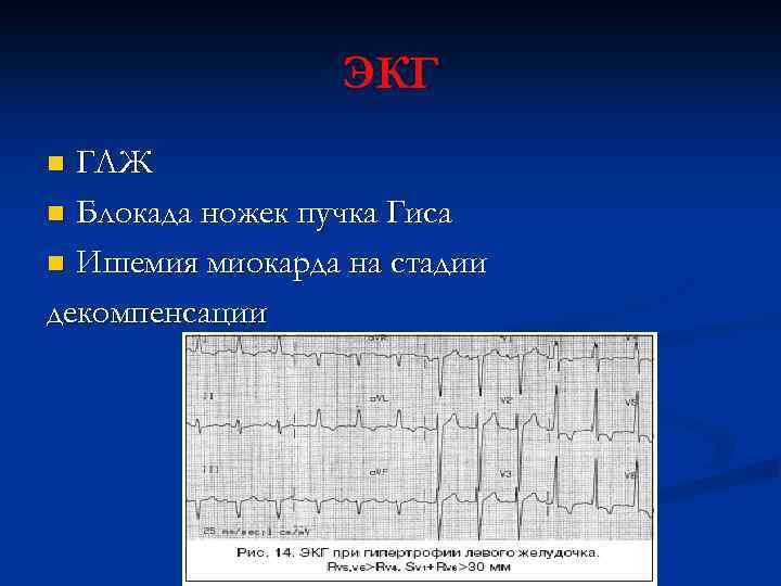 ЭКГ ГЛЖ n Блокада ножек пучка Гиса n Ишемия миокарда на стадии декомпенсации n