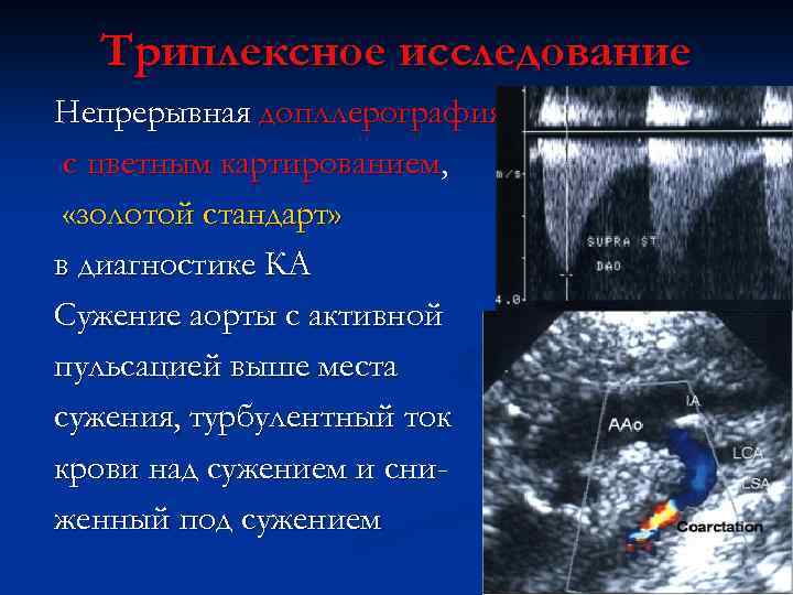 Триплексное исследование Непрерывная допллерография с цветным картированием, «золотой стандарт» в диагностике КА Сужение аорты