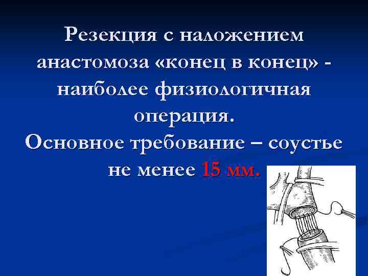 Резекция с наложением анастомоза «конец в конец» наиболее физиологичная операция. Основное требование – соустье