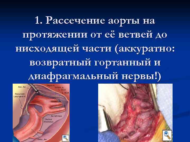 1. Рассечение аорты на протяжении от её ветвей до нисходящей части (аккуратно: возвратный гортанный