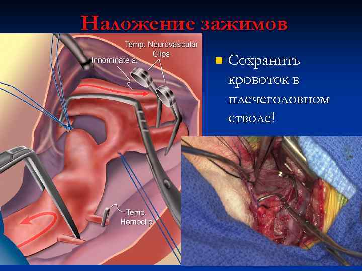 Наложение зажимов n Сохранить кровоток в плечеголовном стволе! 