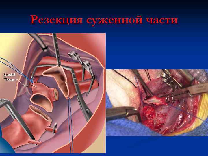 Резекция суженной части 