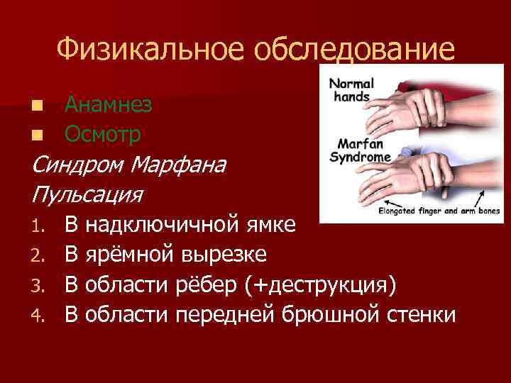 Физикальное обследование Анамнез n Осмотр n Синдром Марфана Пульсация 1. 2. 3. 4. В