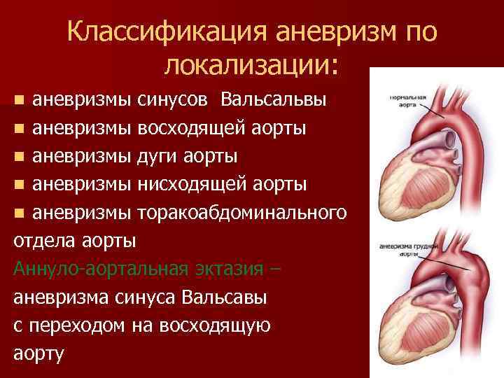 Синус вальсальвы это. Аортальный клапан синус Вальсальвы. Расширение восходящего отдела аорты классификация. Аневризмы синусов Вальсальвы. Классификация аневризмы по локализации.