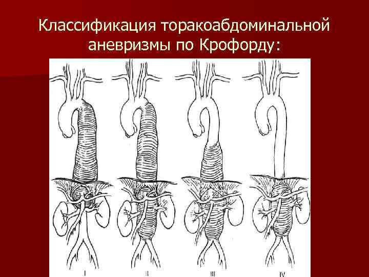 Анастомоз по брауну схема