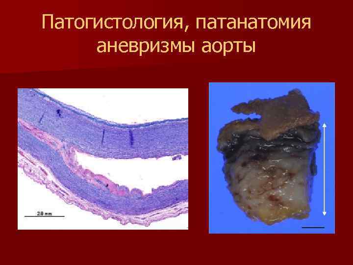 Патогистология, патанатомия аневризмы аорты 