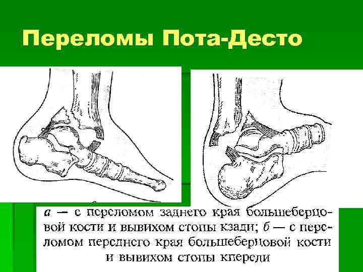 Вывих стопы карта вызова