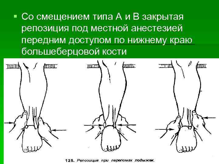 § Со смещением типа А и В закрытая репозиция под местной анестезией передним доступом