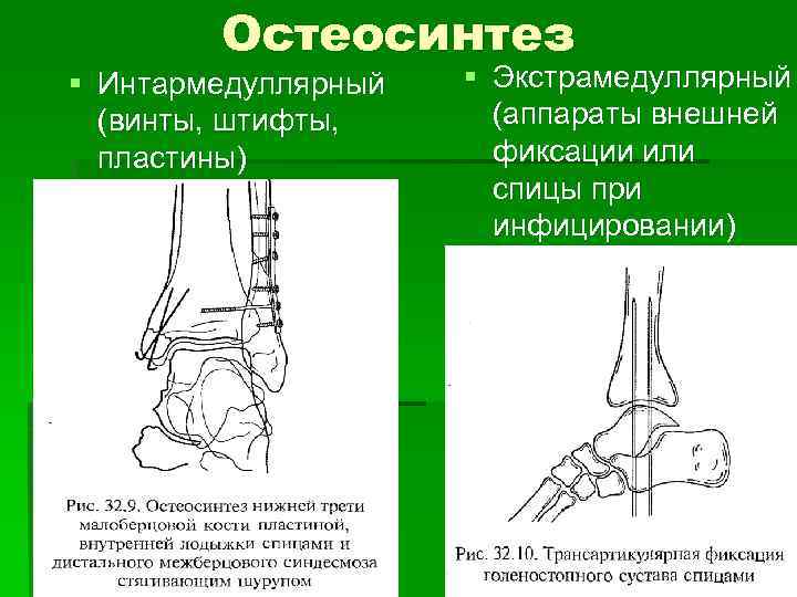 Остеосинтез § Интармедуллярный (винты, штифты, пластины) § Экстрамедуллярный (аппараты внешней фиксации или спицы при