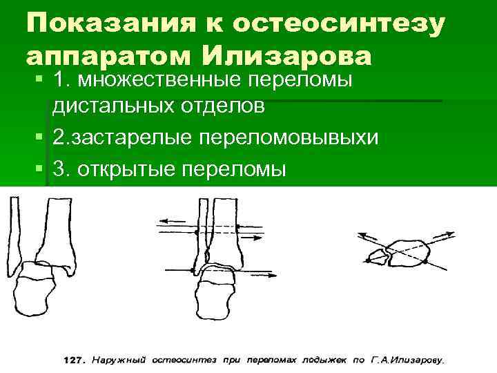 Показания к остеосинтезу аппаратом Илизарова § 1. множественные переломы дистальных отделов § 2. застарелые