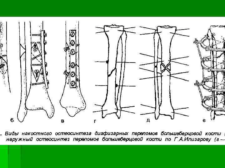 Средняя треть большеберцовой кости