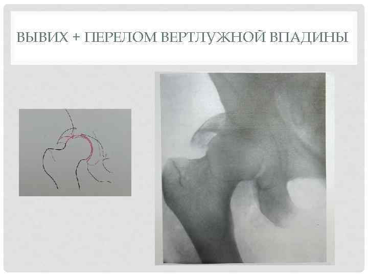 Перелом вертлужной впадины. Перелом вертлужной впадины с вывихом бедра. Перелом впадины тазобедренного сустава. Перелом дна вертлужной впадины с центральным вывихом бедра. Перелом вертлужной впадины с центральным вывихом бедра.