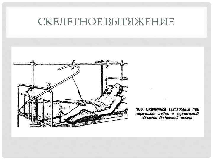 СКЕЛЕТНОЕ ВЫТЯЖЕНИЕ 