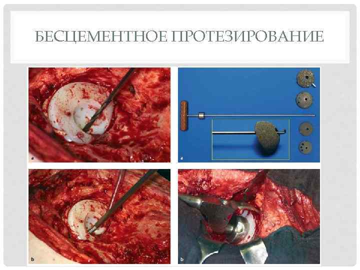 БЕСЦЕМЕНТНОЕ ПРОТЕЗИРОВАНИЕ 