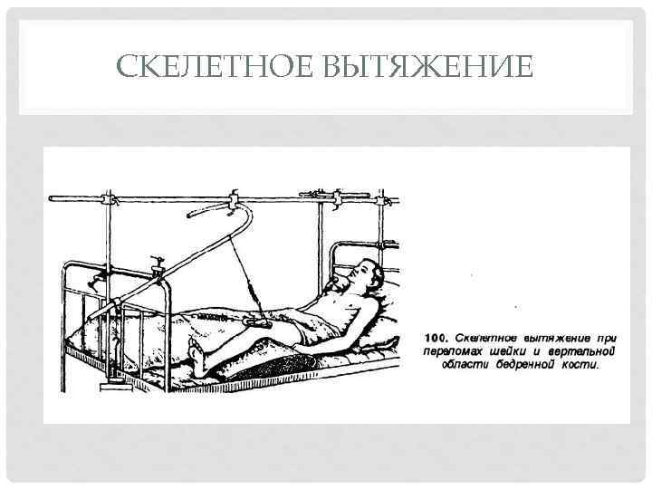 Схема скелетного вытяжения при переломах бедренной кости