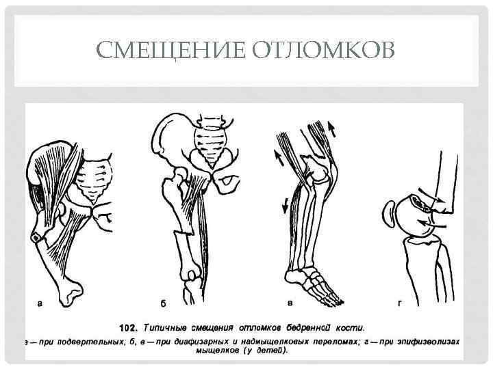 Перелом лучевой кости в типичном месте карта вызова закрытый