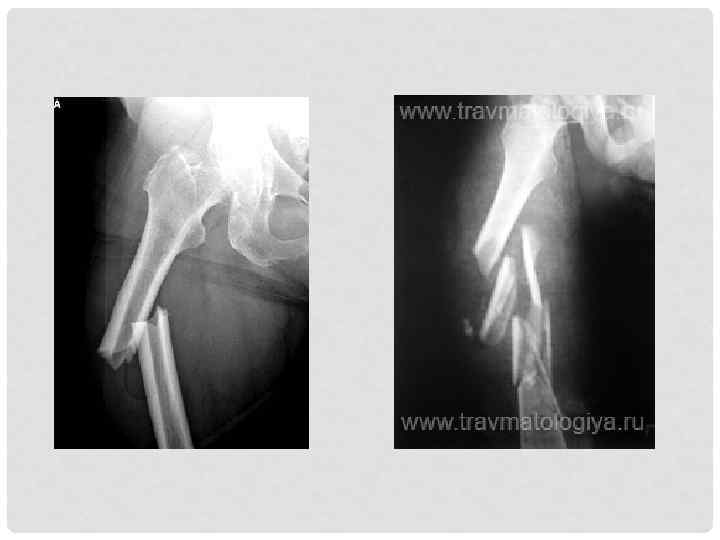 Перелом бедренного костя. Перелом диафиза бедренной кости клиника. Перелом бедренной кости со смещением рентген. Поперечный перелом бедра рентген. Рентгенограммы с переломом диафиза бедренной кости.