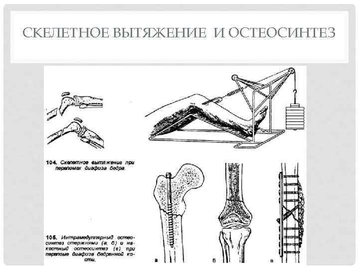 Скелетное вытяжение. Скелетное вытяжение для остеосинтеза. Скелетное вытяжение за мыщелки бедра. Оснащение для скелетного вытяжения. Внеочаговый остеосинтез и скелетное вытяжение.