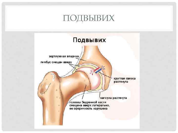 ПОДВЫВИХ 