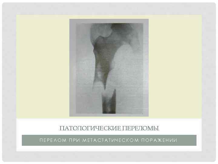 ПАТОЛОГИЧЕСКИЕ ПЕРЕЛОМЫ ПЕРЕЛОМ ПРИ МЕТАСТАТИЧЕСКОМ ПОРАЖЕНИИ 