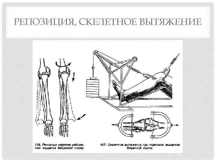 Скелетное вытяжение это