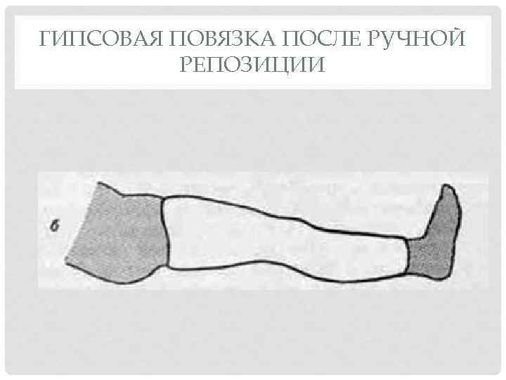 ГИПСОВАЯ ПОВЯЗКА ПОСЛЕ РУЧНОЙ РЕПОЗИЦИИ 