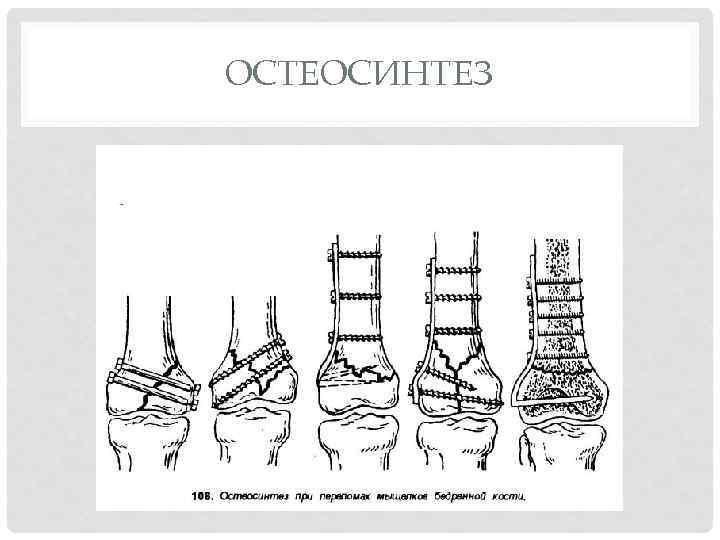 ОСТЕОСИНТЕЗ 