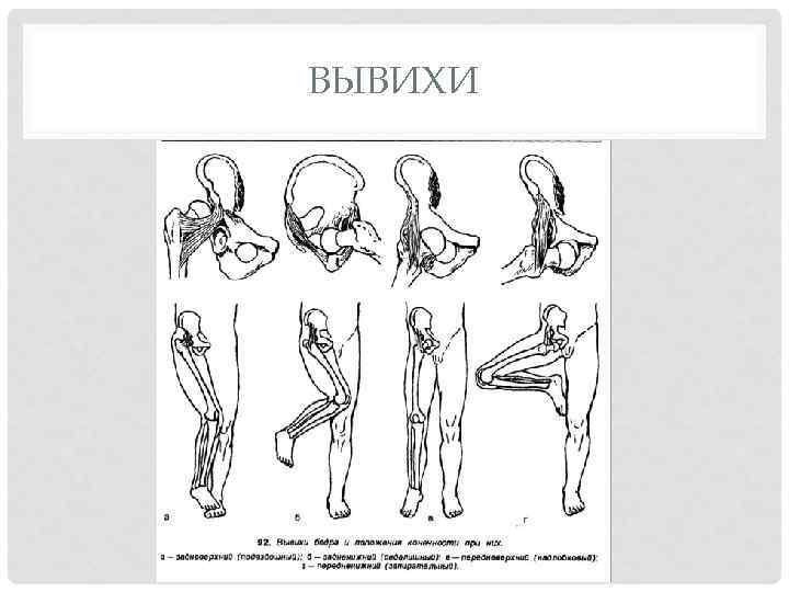 Вывих тазобедренного сустава карта вызова