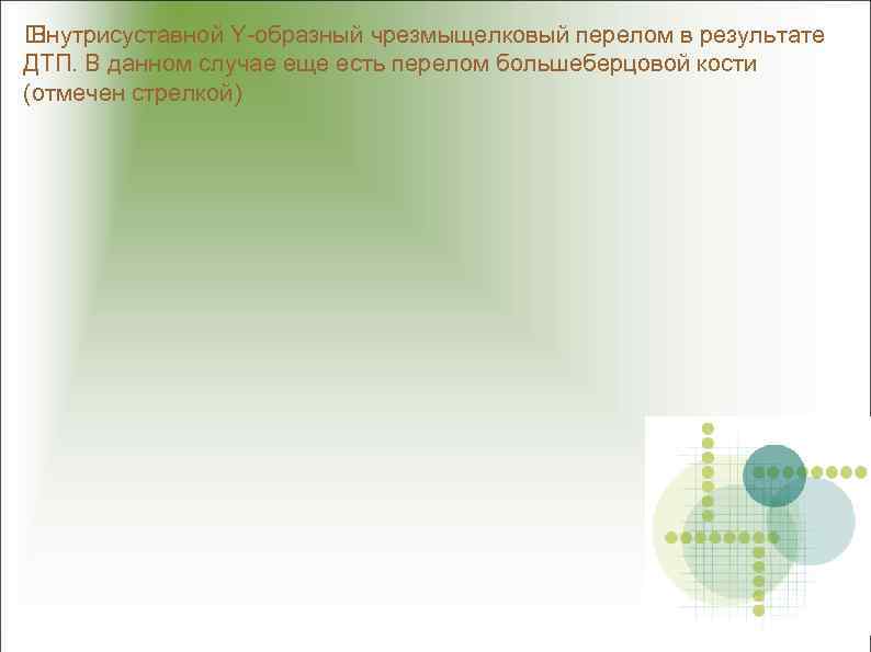  Внутрисуставной Y-образный чрезмыщелковый перелом в результате ДТП. В данном случае еще есть перелом
