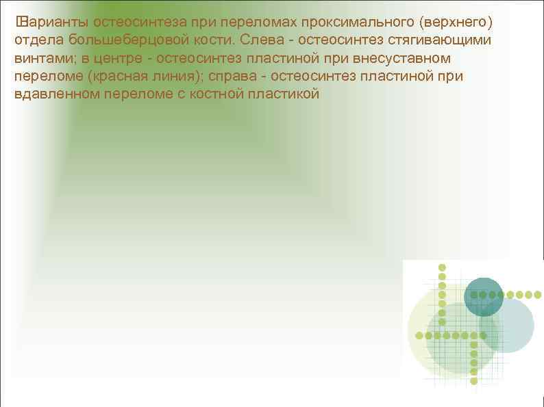  Варианты остеосинтеза при переломах проксимального (верхнего) отдела большеберцовой кости. Слева - остеосинтез стягивающими