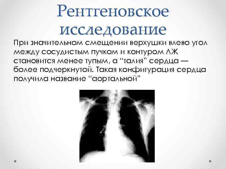 Рентгеновское исследование При значительном смещении верхушки влево угол между сосудистым пучком и контуром ЛЖ