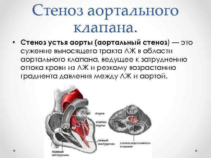 Стеноз аортального клапана. • Стеноз устья аорты (аортальный стеноз) — это сужение выносящего тракта