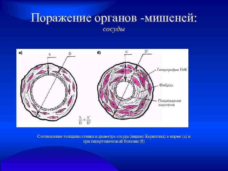 Поражение органов -мишеней: сосуды Соотношение толщины стенки и диаметра сосуда (индекс Керногана) в норме