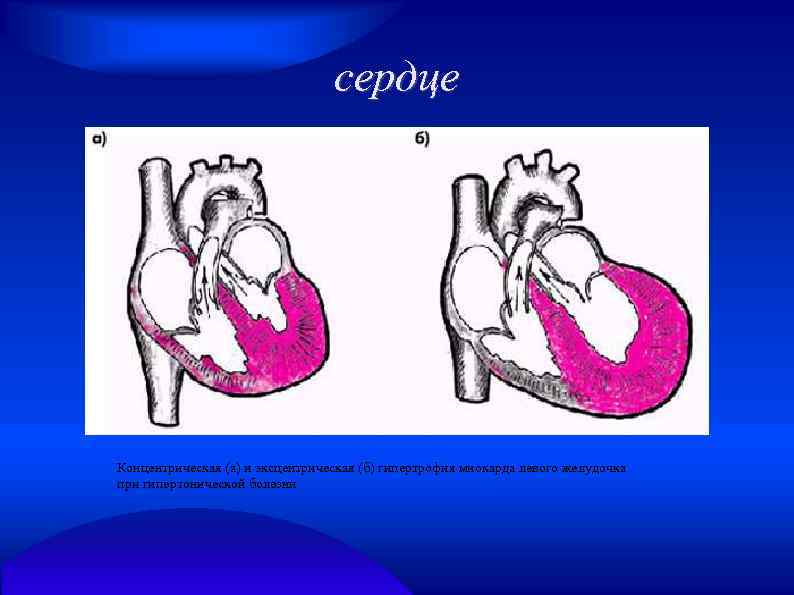 сердце Концентрическая (а) и эксцентрическая (б) гипертрофия миокарда левого желудочка при гипертонической болезни 