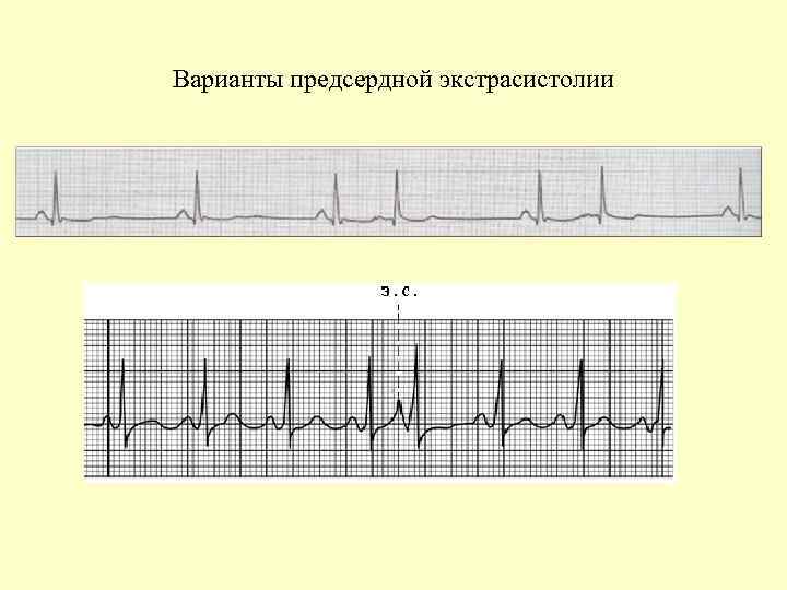 Варианты предсердной экстрасистолии 