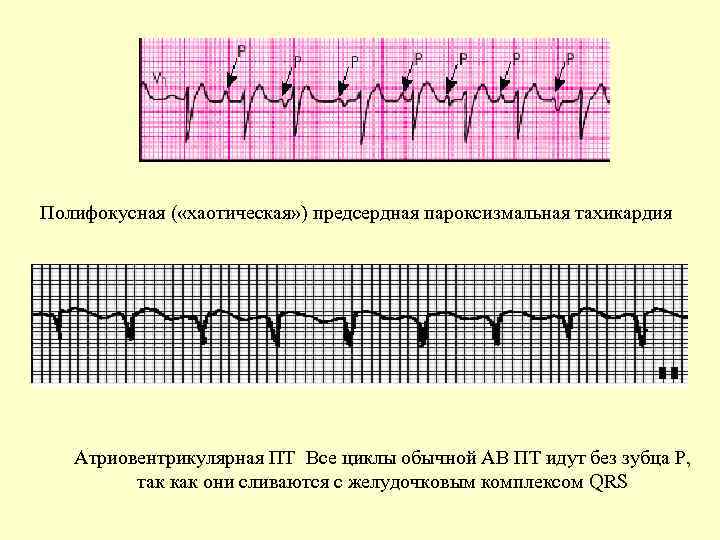 Полифокусная ( «хаотическая» ) предсердная пароксизмальная тахикардия Атриовентрикулярная ПТ Все циклы обычной АВ ПТ