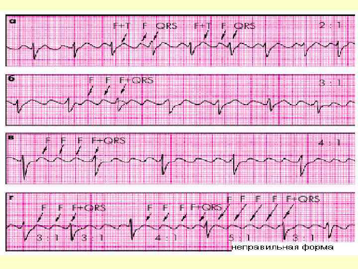Фибрилляция предсердий на экг. Трепетание предсердий на ЭКГ. Трепетание предсердий 1 к 1 на ЭКГ. Трепетание предсердий 2 к 1 на ЭКГ. ФП И трепетание предсердий ЭКГ.