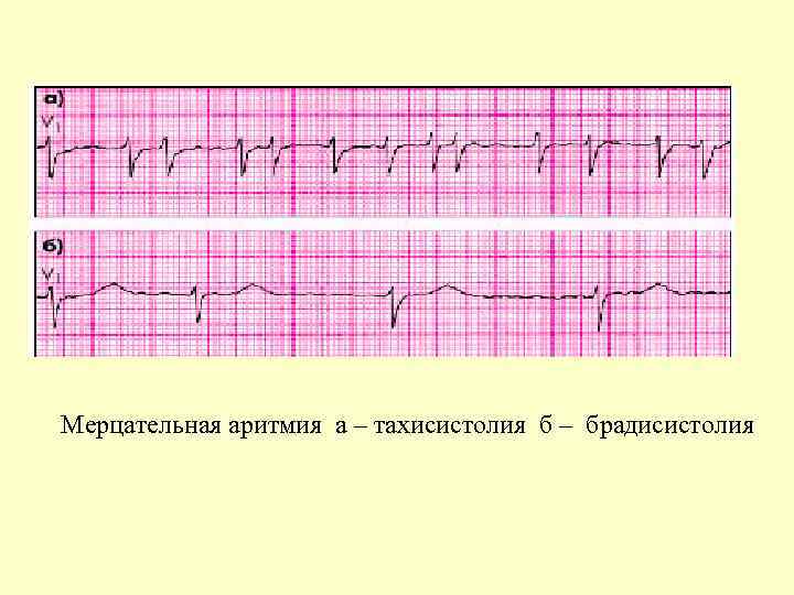 Мерцательная аритмия а – тахисистолия б – брадисистолия 