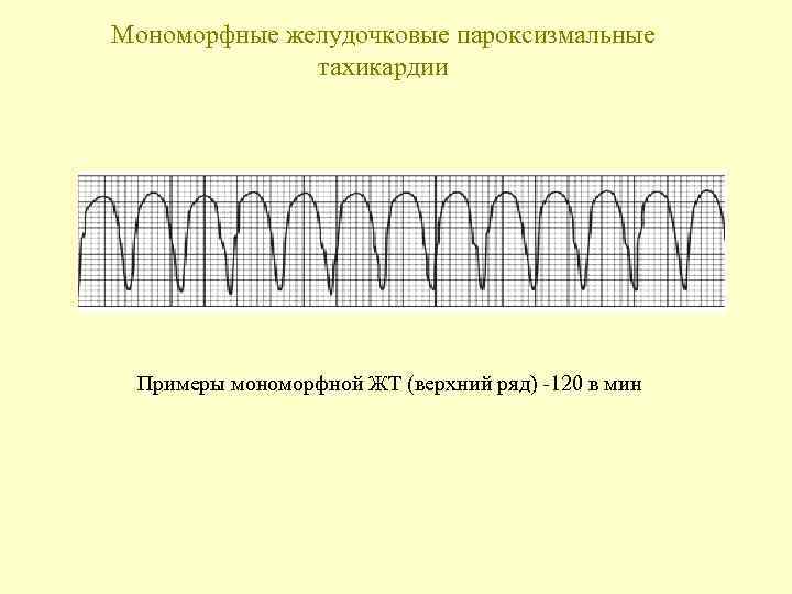 Мономорфные желудочковые пароксизмальные тахикардии Примеры мономорфной ЖТ (верхний ряд) -120 в мин 