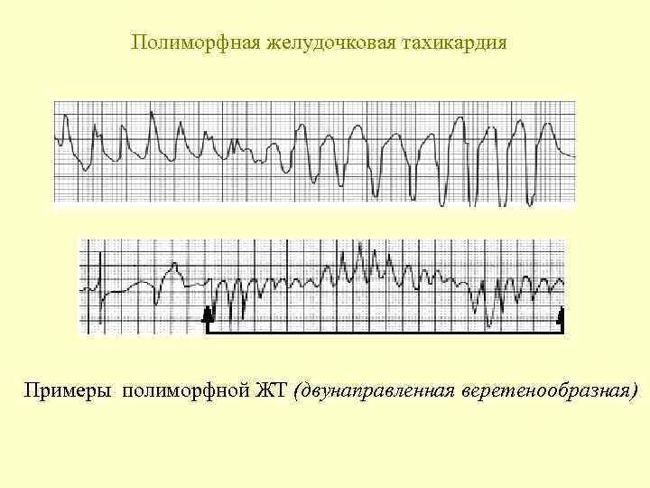 Полиморфная желудочковая тахикардия Примеры полиморфной ЖТ (двунаправленная веретенообразная) 