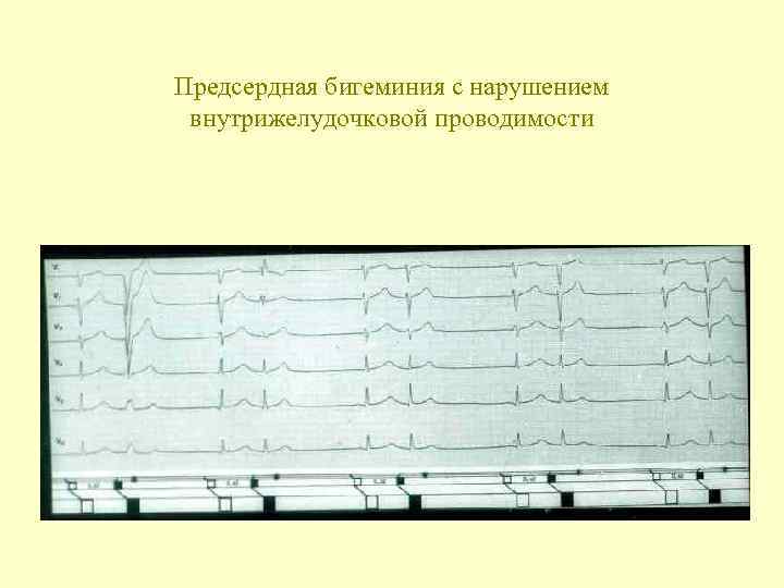 Предсердная бигеминия с нарушением внутрижелудочковой проводимости 