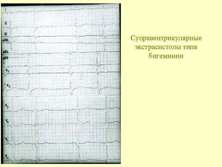 Нарушение ритма по типу бигеминии карта вызова